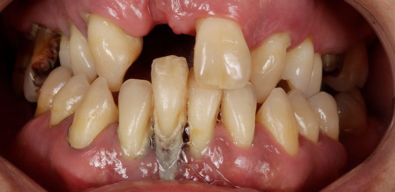 Implantes dentales en Motril