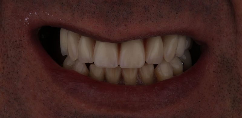 Cirugía e Implantes dentales Motril
