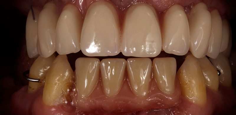 Cirugía e Implantes dentales Motril