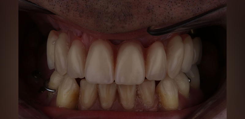 Implantes dentales en Motril