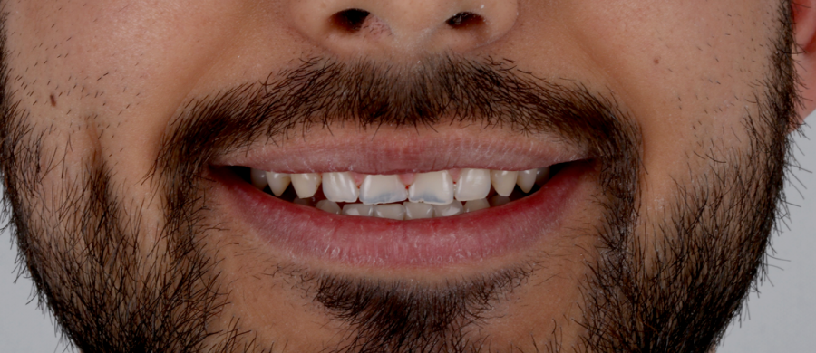 Estética dental en Motril. Disfruta de tu sonrisa.