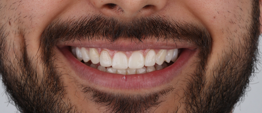Estética dental en Motril. Disfruta de tu sonrisa.