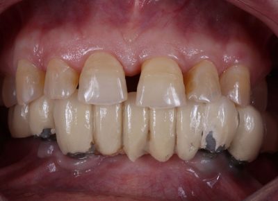 prótesis dentales en Motril